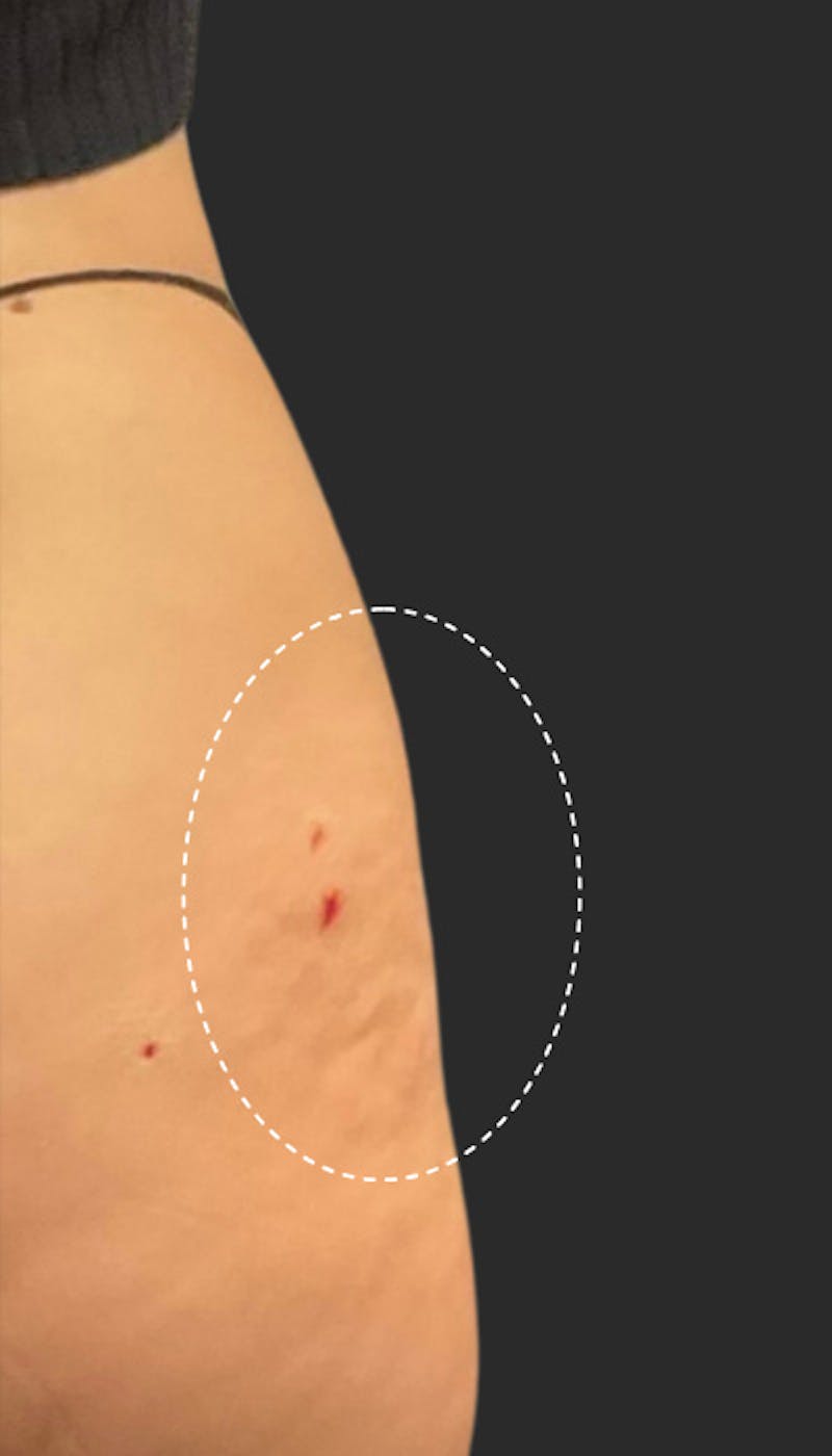 Buttlift & Hip Dips Before & After Gallery - Patient 328805 - Image 2