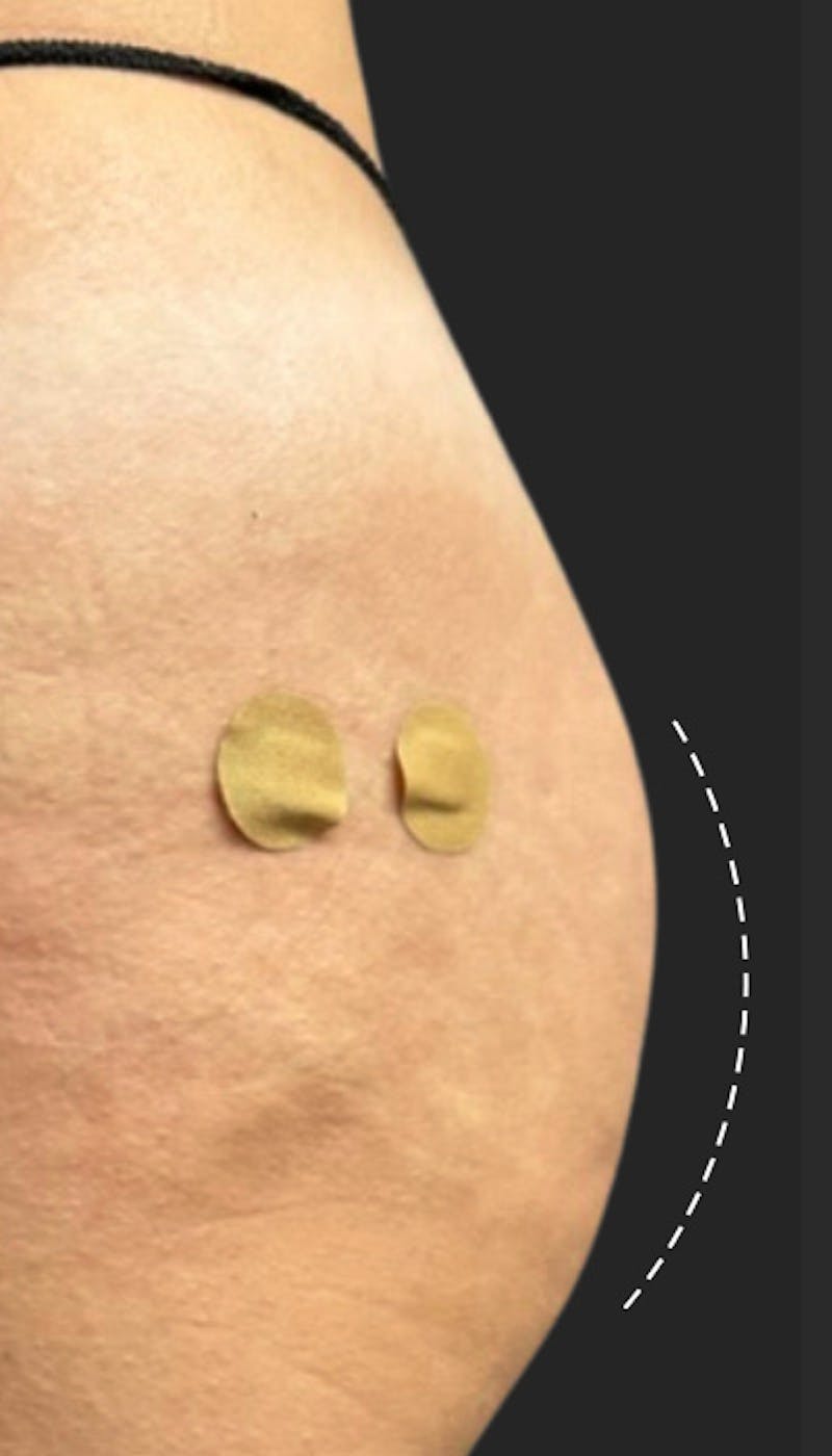 Buttlift & Hip Dips Before & After Gallery - Patient 212276 - Image 2