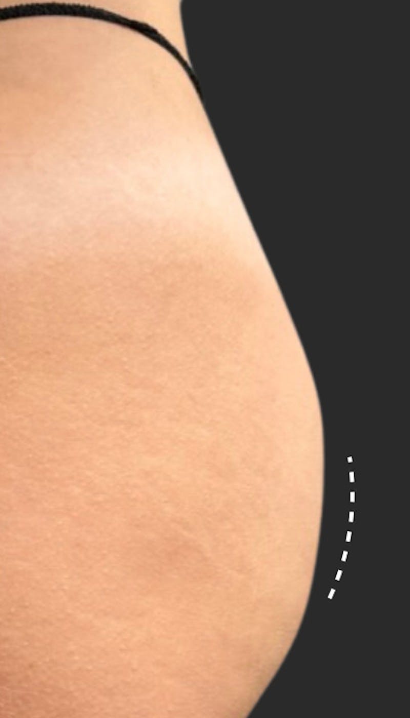 Buttlift & Hip Dips Before & After Gallery - Patient 212276 - Image 1