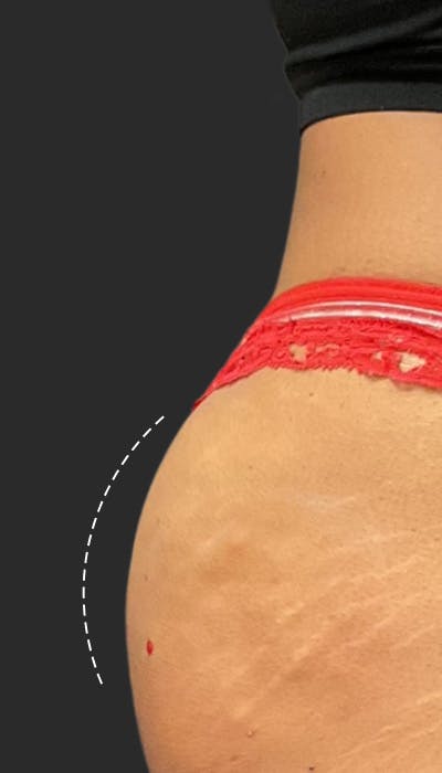 Buttlift & Hip Dips Before & After Gallery - Patient 147383 - Image 2