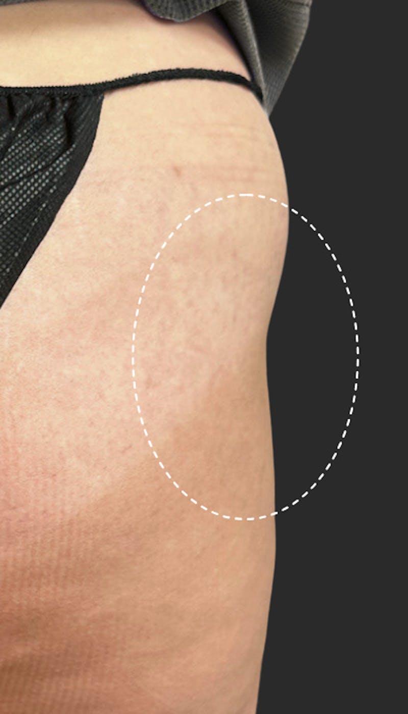 Buttlift & Hip Dips Before & After Gallery - Patient 170607 - Image 1