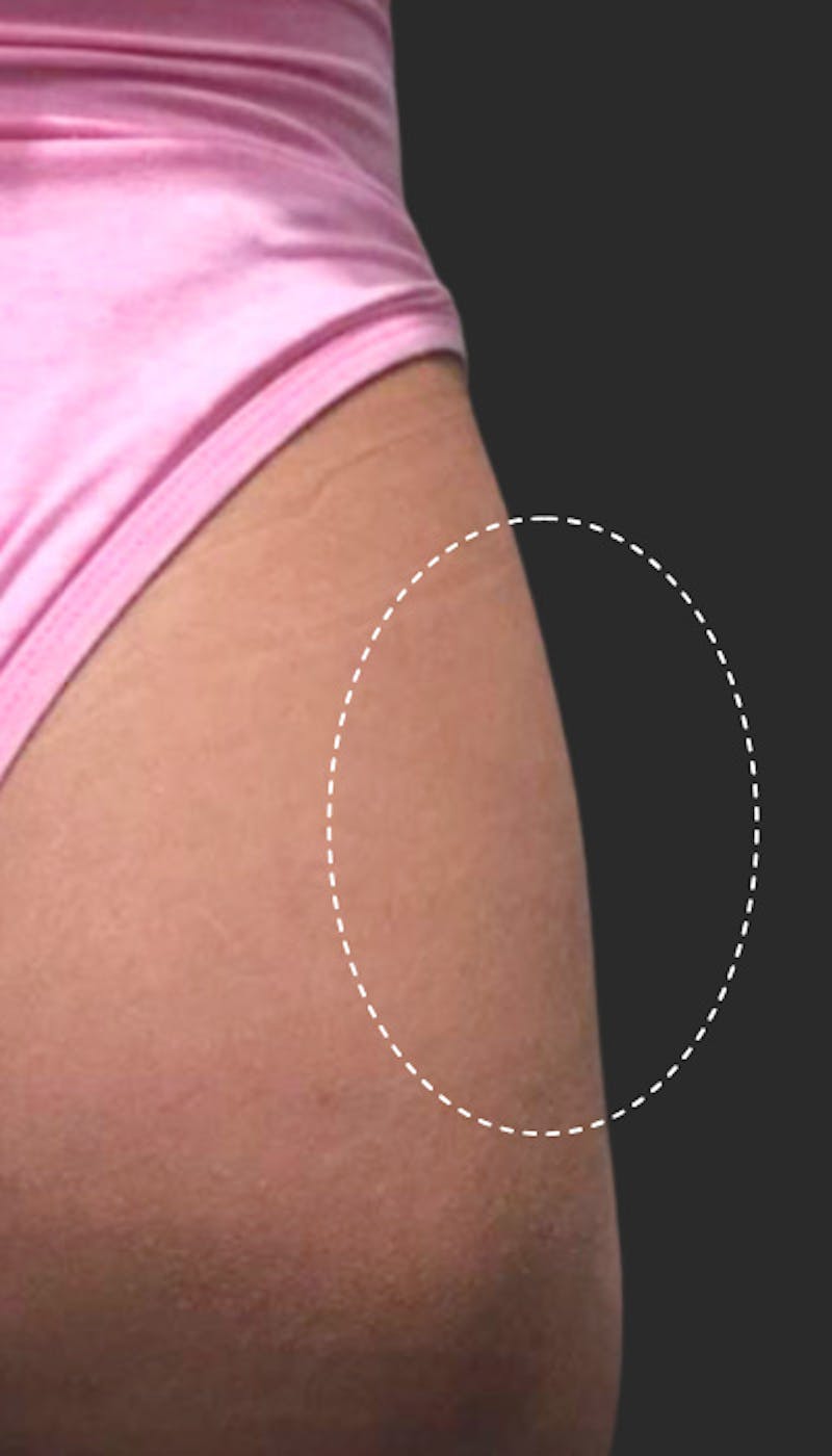 Buttlift & Hip Dips Before & After Gallery - Patient 108106 - Image 2