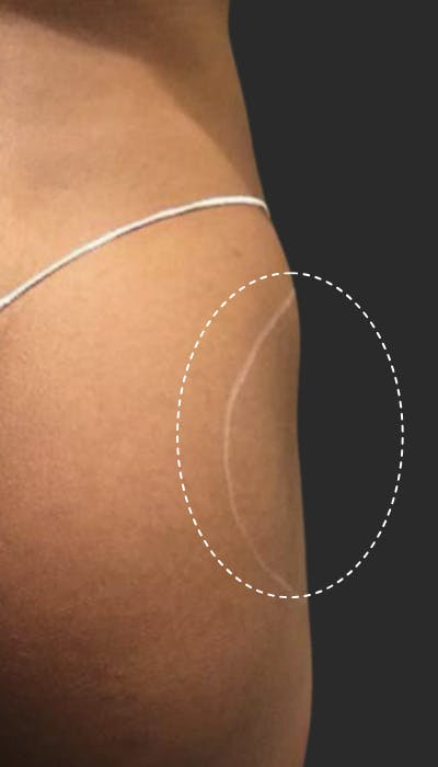 Buttlift & Hip Dips Before & After Gallery - Patient 108106 - Image 1