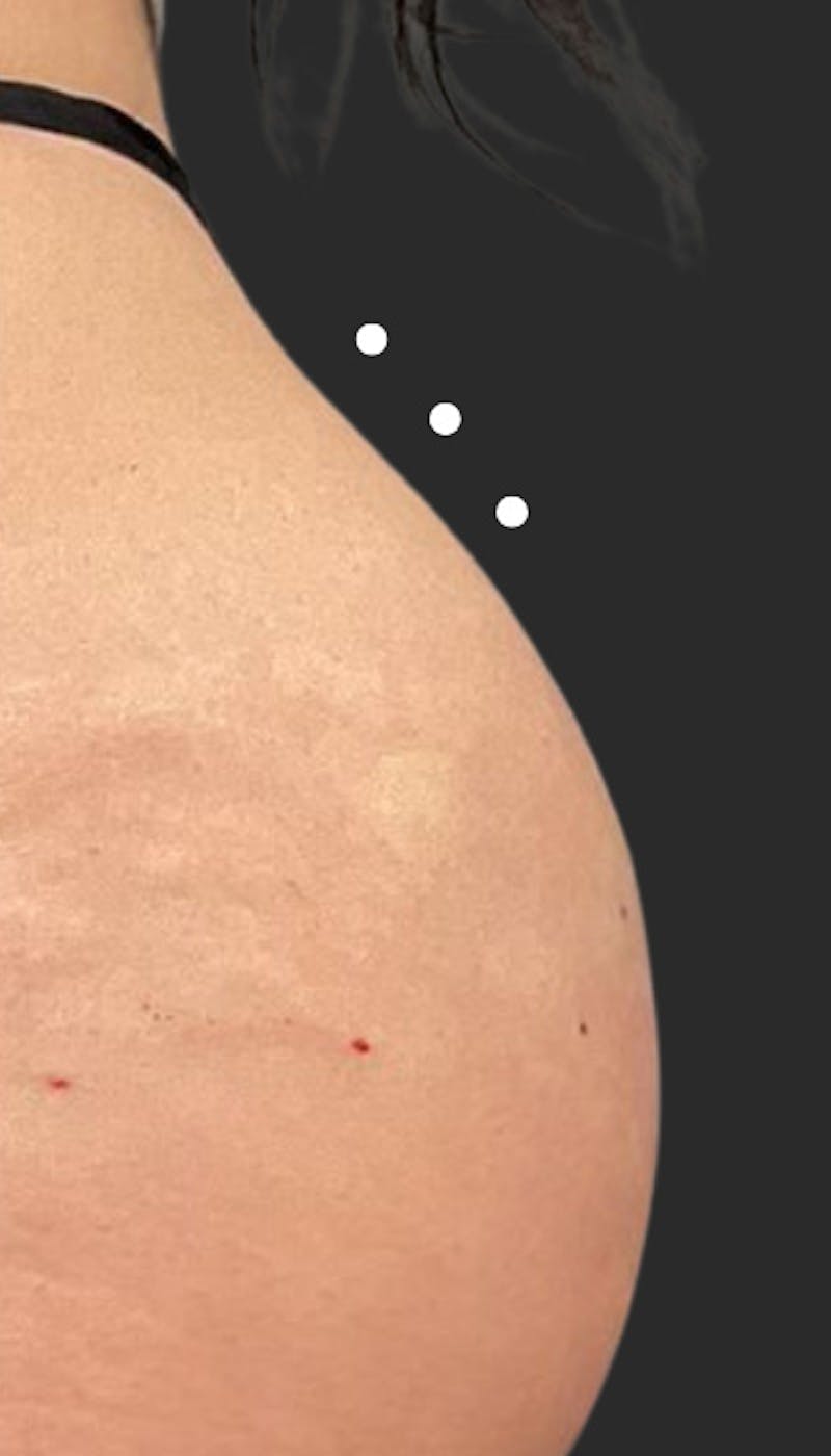Buttlift & Hip Dips Before & After Gallery - Patient 517263 - Image 2