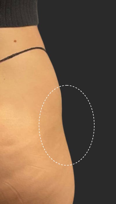 Buttlift & Hip Dips Before & After Gallery - Patient 328805 - Image 1