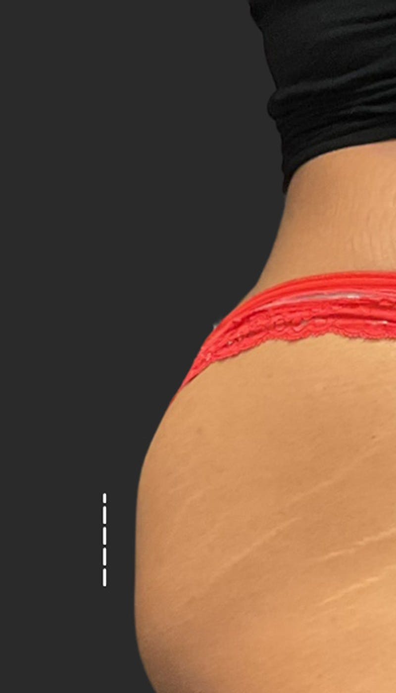 Buttlift & Hip Dips Before & After Gallery - Patient 147383 - Image 1