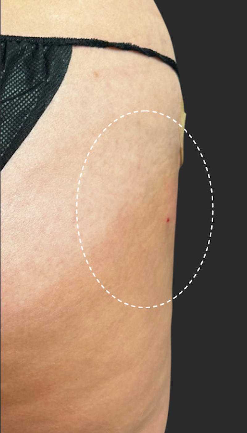 Buttlift & Hip Dips Before & After Gallery - Patient 170607 - Image 2