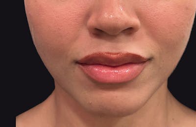 Botox for TMJ / Jaw Before & After Gallery - Patient 134533 - Image 1