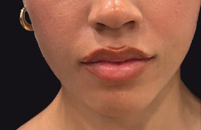 Botox for TMJ / Jaw Before & After Gallery - Patient 134533 - Image 2