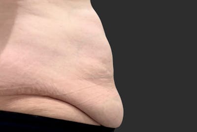 Coolsculpting Body Fat Reduction Before & After Gallery - Patient 401429 - Image 1