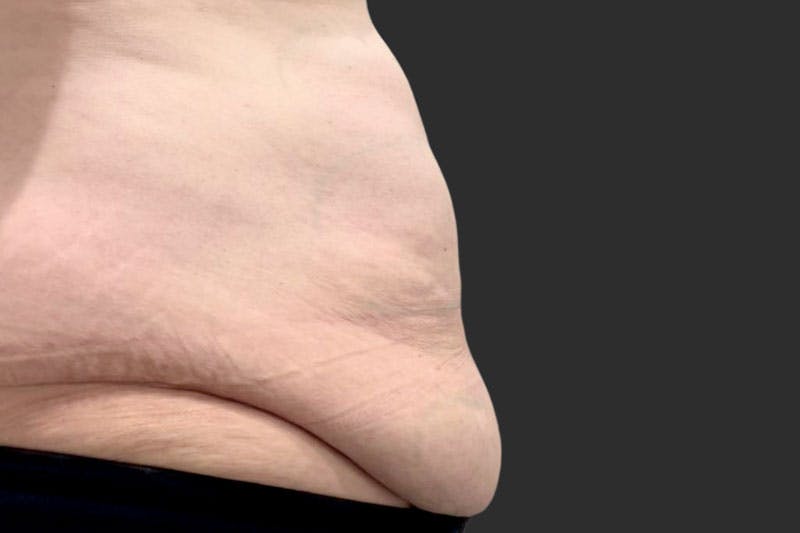 Coolsculpting Body Fat Reduction Before & After Gallery - Patient 401429 - Image 1
