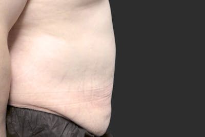 Coolsculpting Body Fat Reduction Before & After Gallery - Patient 401429 - Image 2