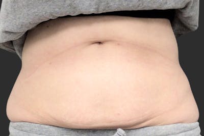 Coolsculpting Body Fat Reduction Before & After Gallery - Patient 213140 - Image 1