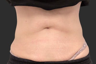 Coolsculpting Body Fat Reduction Before & After Gallery - Patient 213140 - Image 2