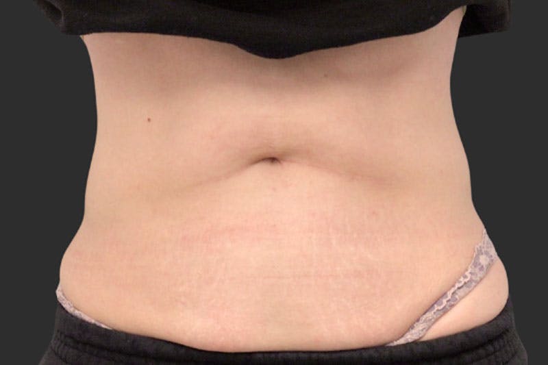 Coolsculpting Body Fat Reduction Before & After Gallery - Patient 213140 - Image 2