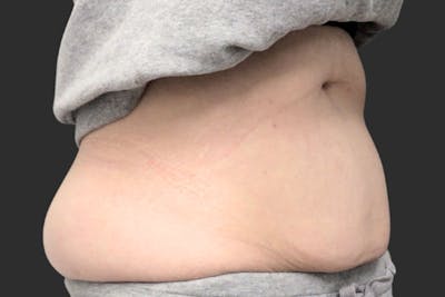 Coolsculpting Body Fat Reduction Before & After Gallery - Patient 192915 - Image 1
