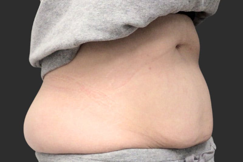 Coolsculpting Body Fat Reduction Before & After Gallery - Patient 192915 - Image 1