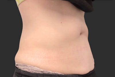 Coolsculpting Body Fat Reduction Before & After Gallery - Patient 192915 - Image 2