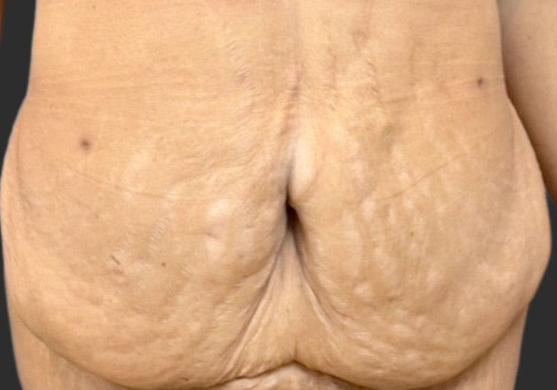 Tummy Tuck Before & After Gallery - Patient 112422 - Image 1