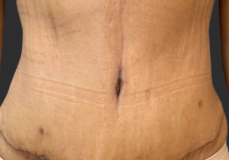 Tummy Tuck Before & After Gallery - Patient 112422 - Image 2