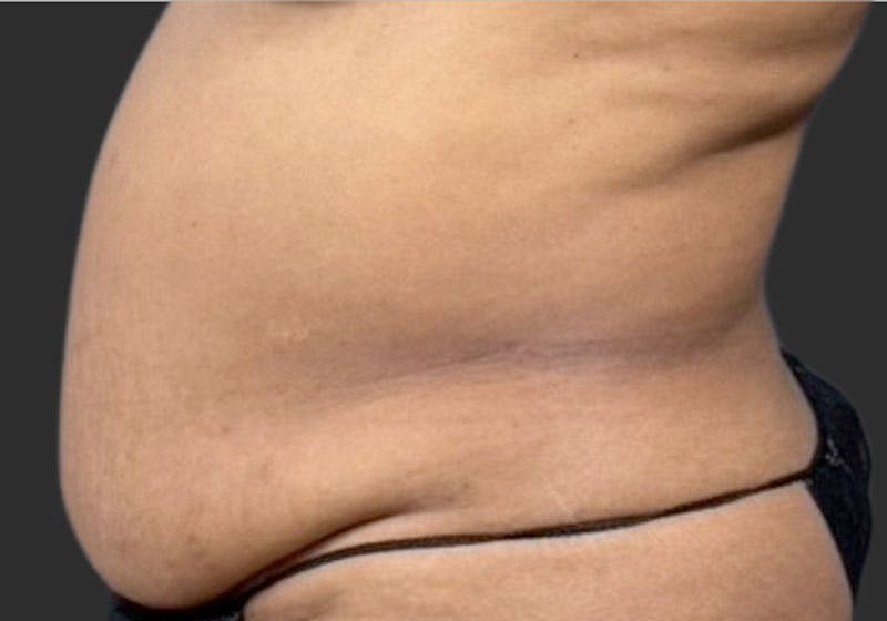 Tummy Tuck Before & After Gallery - Patient 346497 - Image 1