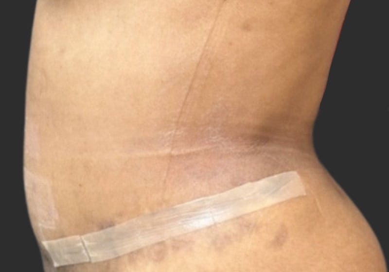 Tummy Tuck Before & After Gallery - Patient 346497 - Image 2