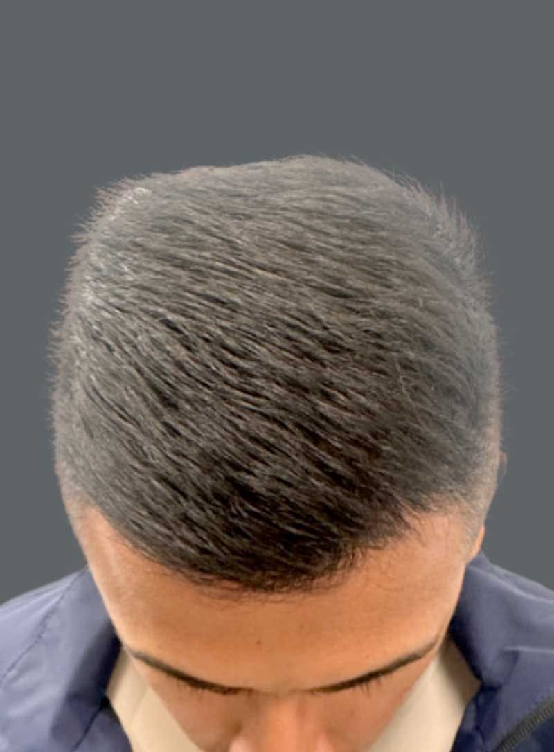 Hair Transplant Before & After Gallery - Patient 176499 - Image 2