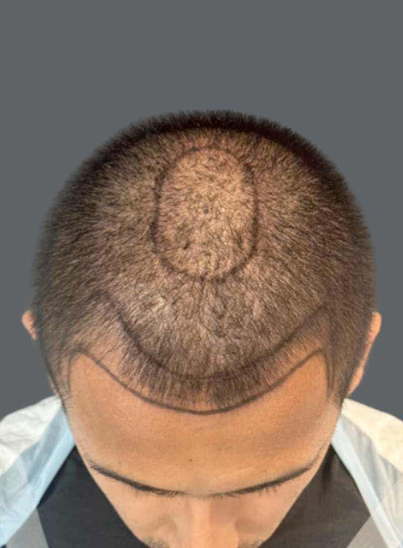 Hair Transplant Before & After Gallery - Patient 176499 - Image 1