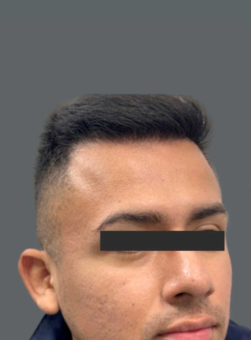 Hair Transplant Before & After Gallery - Patient 290973 - Image 2