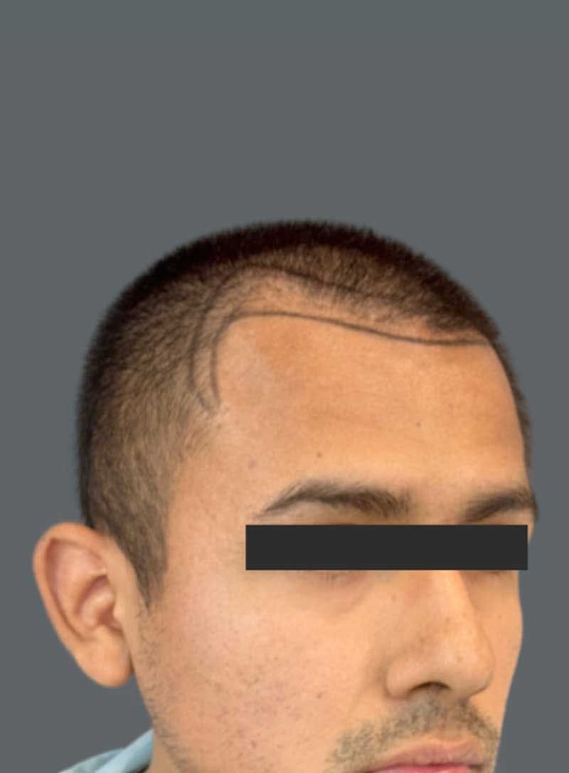 Hair Transplant Before & After Gallery - Patient 290973 - Image 1