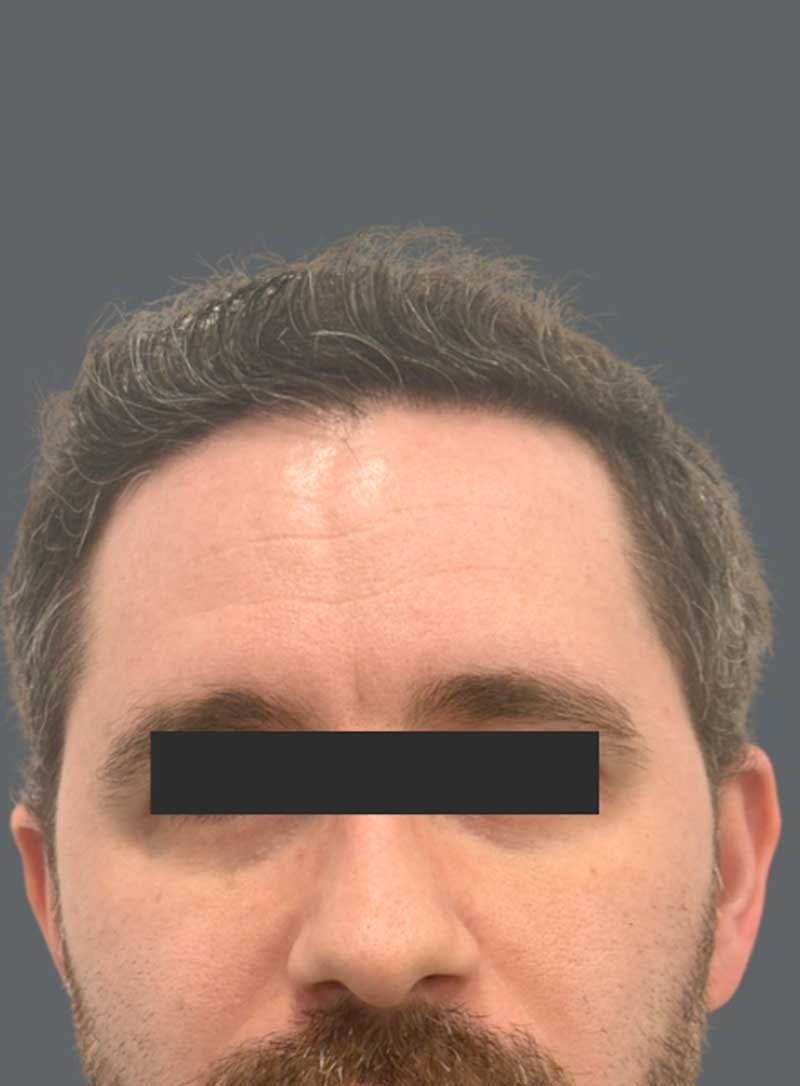 Hair Transplant Before & After Gallery - Patient 322557 - Image 2