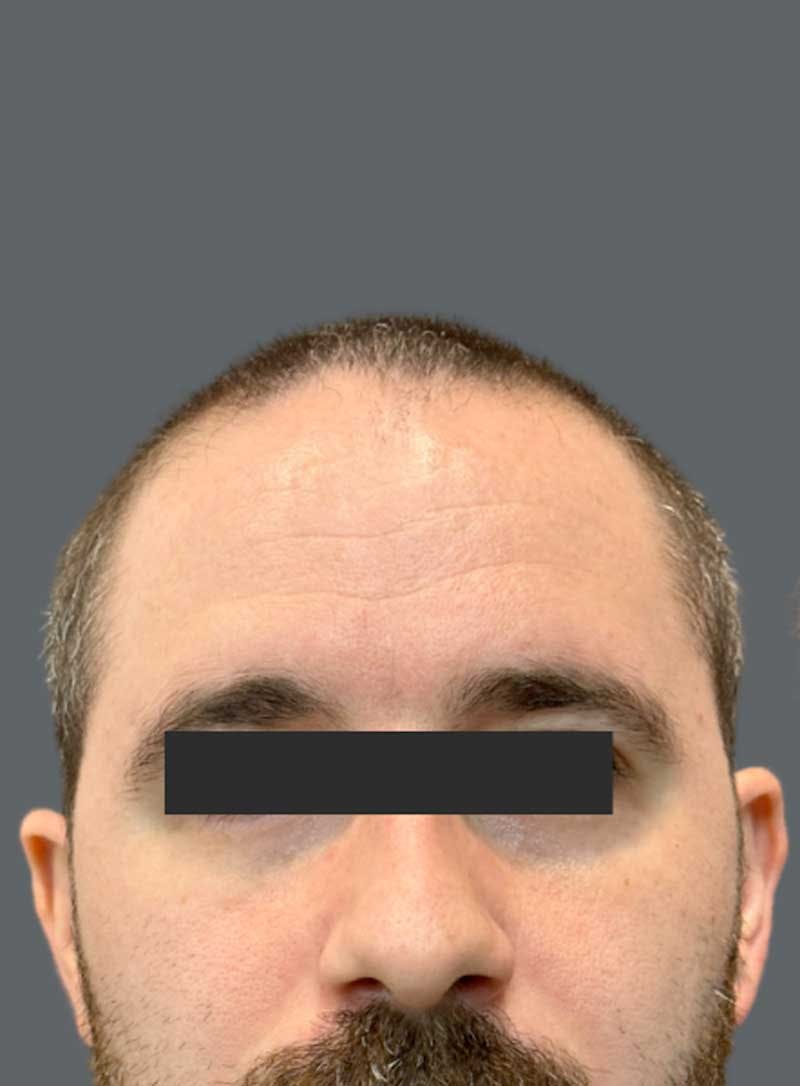 Hair Transplant Before & After Gallery - Patient 322557 - Image 1