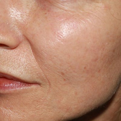 Microneedle Skin Rejuvenation Before & After Gallery - Patient 595930 - Image 2