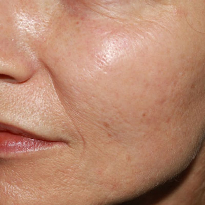 Microneedle Skin Rejuvenation Before & After Gallery - Patient 595930 - Image 2