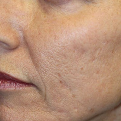 Microneedle Skin Rejuvenation Before & After Gallery - Patient 595930 - Image 1