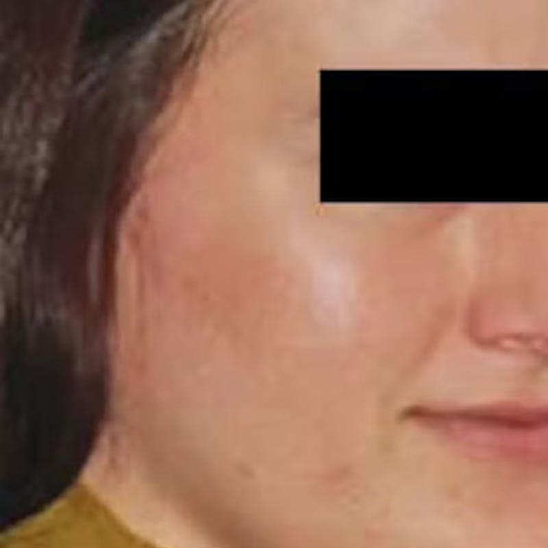 Microneedle Skin Rejuvenation Before & After Gallery - Patient 171971 - Image 2