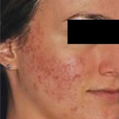 Microneedle Skin Rejuvenation Before & After Gallery - Patient 171971 - Image 1