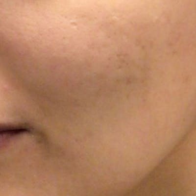 Microneedle Skin Rejuvenation Before & After Gallery - Patient 162045 - Image 2