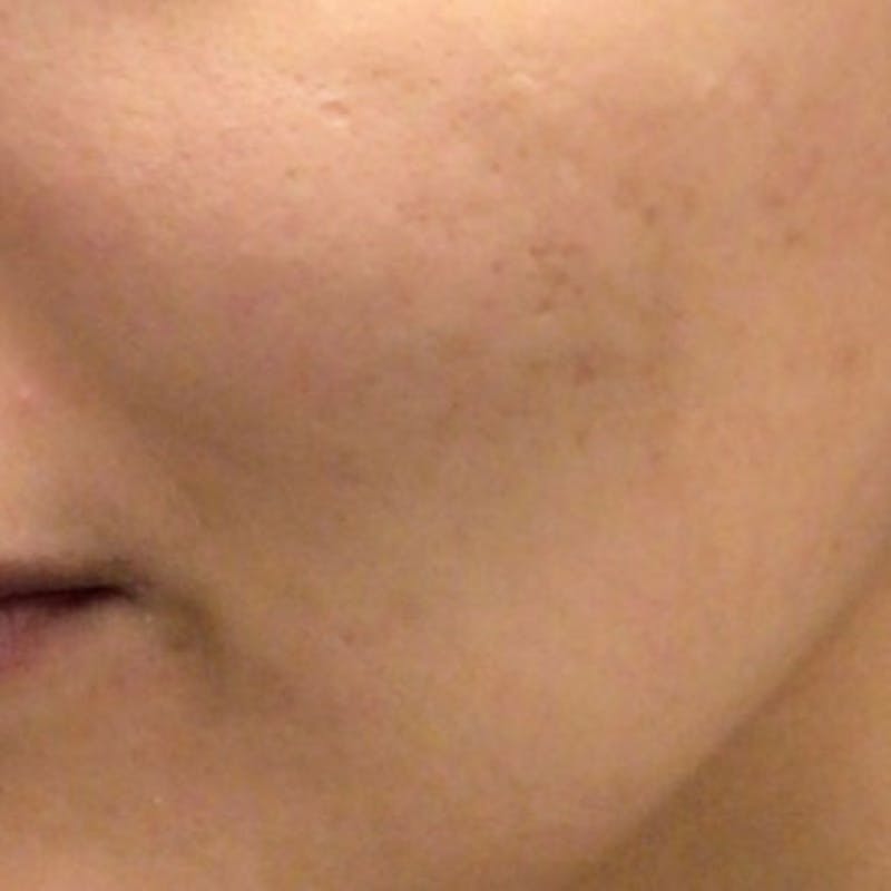 Microneedle Skin Rejuvenation Before & After Gallery - Patient 162045 - Image 2
