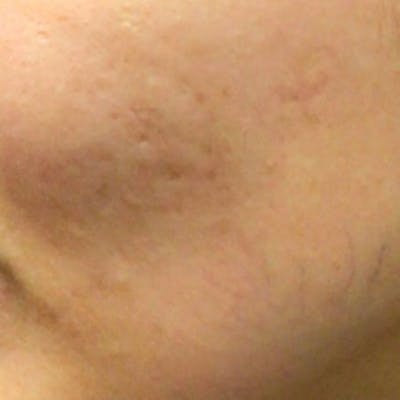 Microneedle Skin Rejuvenation Before & After Gallery - Patient 162045 - Image 1