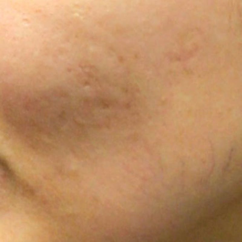 Microneedle Skin Rejuvenation Before & After Gallery - Patient 162045 - Image 1