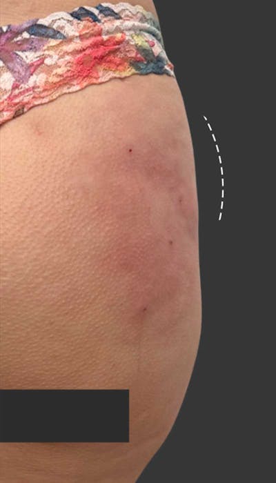 Buttlift & Hip Dips Before & After Gallery - Patient 357280 - Image 2