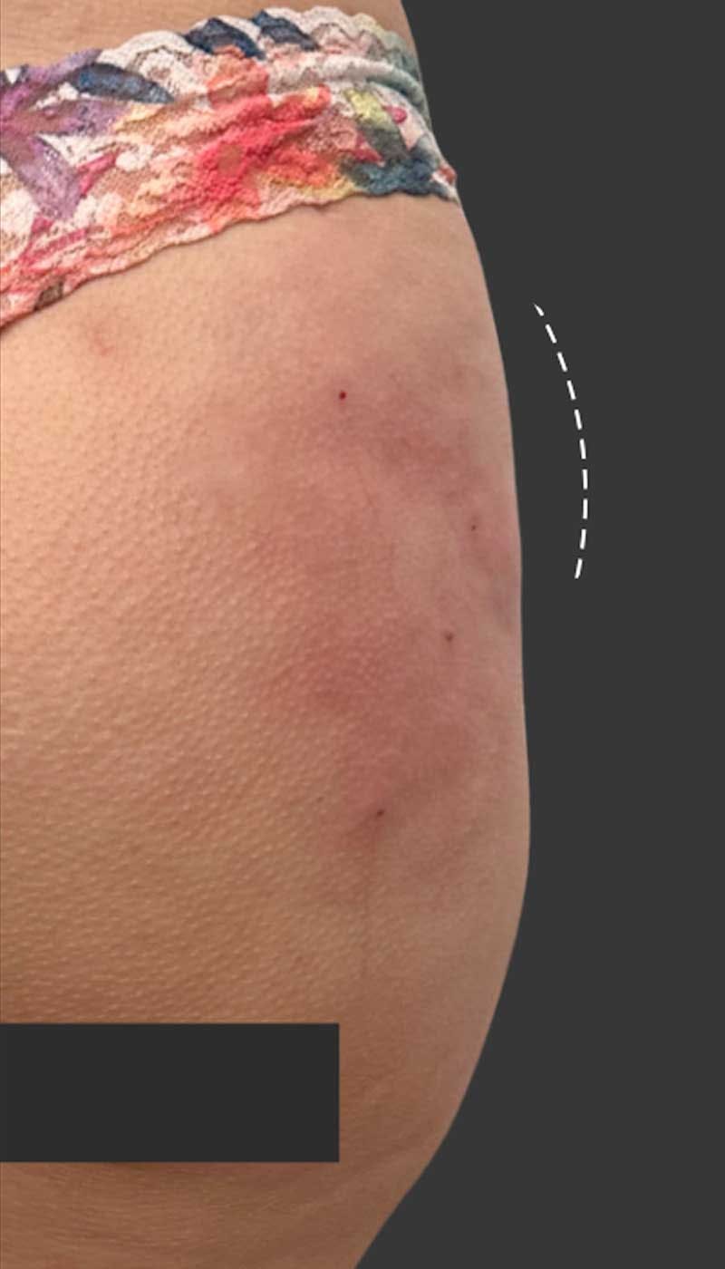 Buttlift & Hip Dips Before & After Gallery - Patient 357280 - Image 2