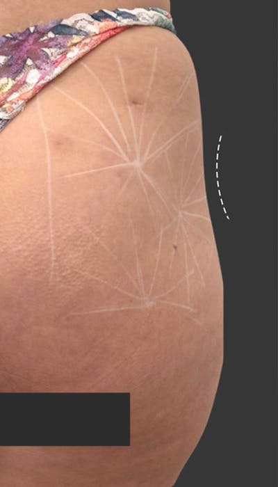 Buttlift & Hip Dips Before & After Gallery - Patient 357280 - Image 1