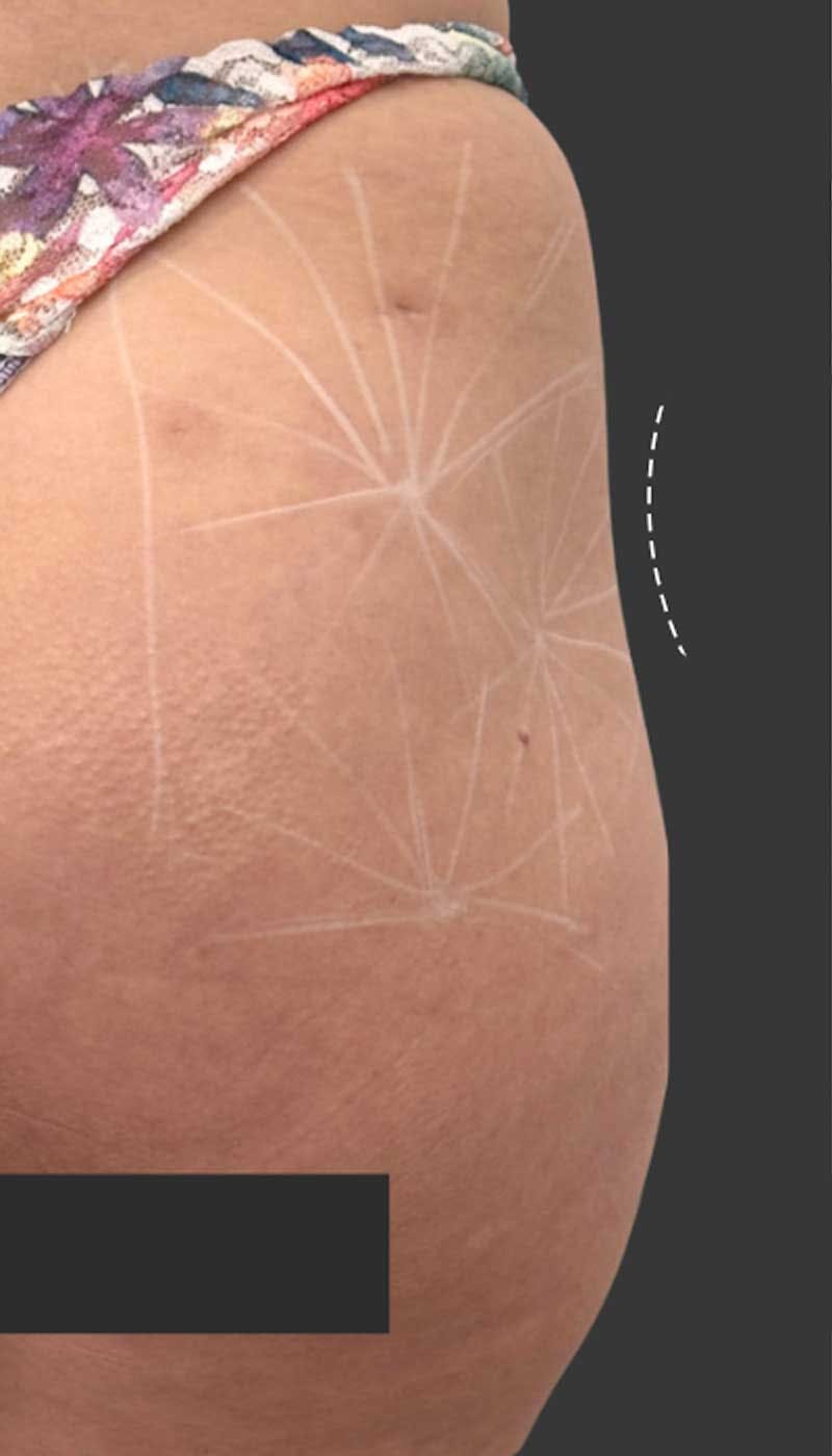 Buttlift & Hip Dips Before & After Gallery - Patient 357280 - Image 1