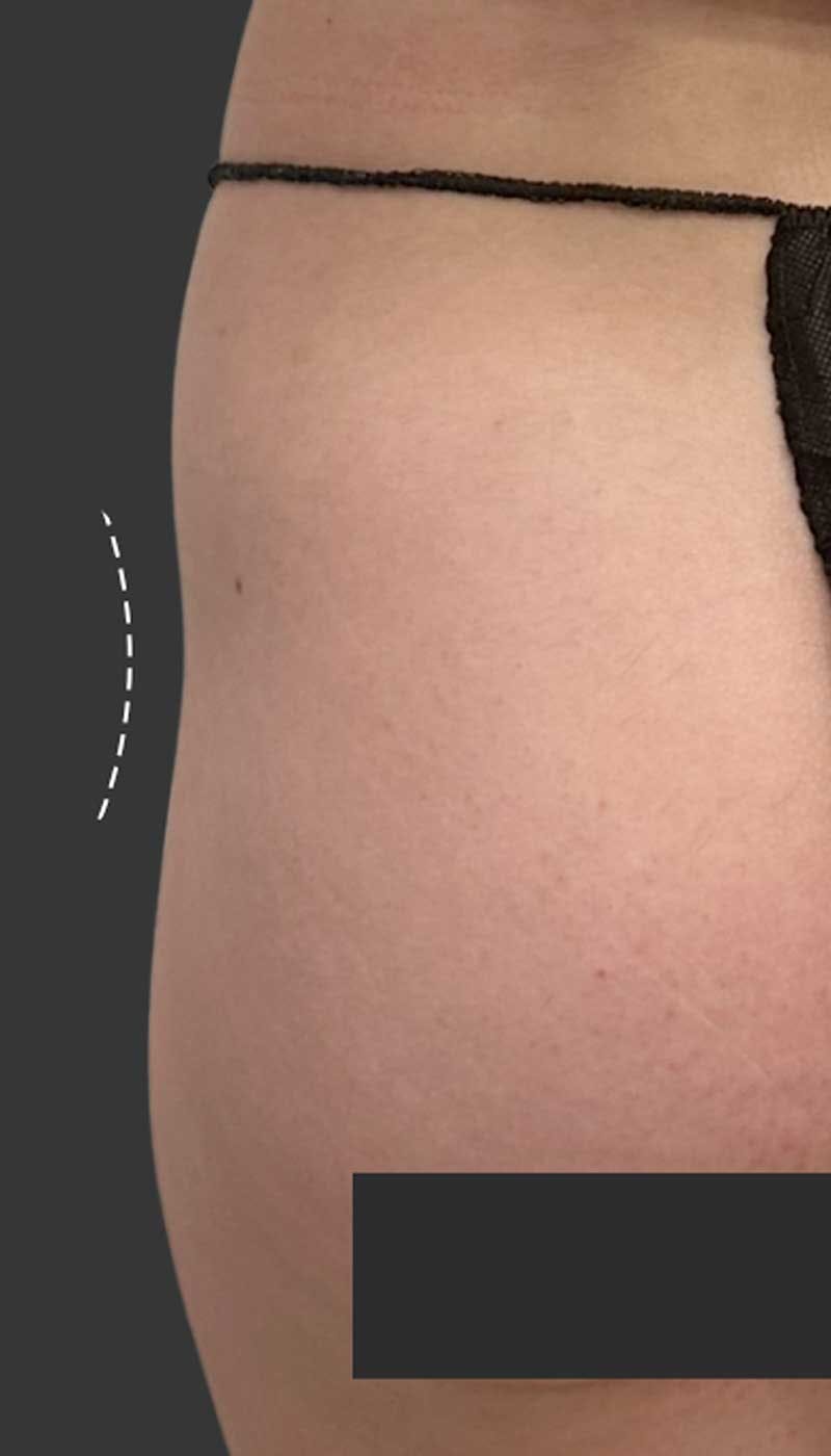 Buttlift & Hip Dips Before & After Gallery - Patient 363608 - Image 1