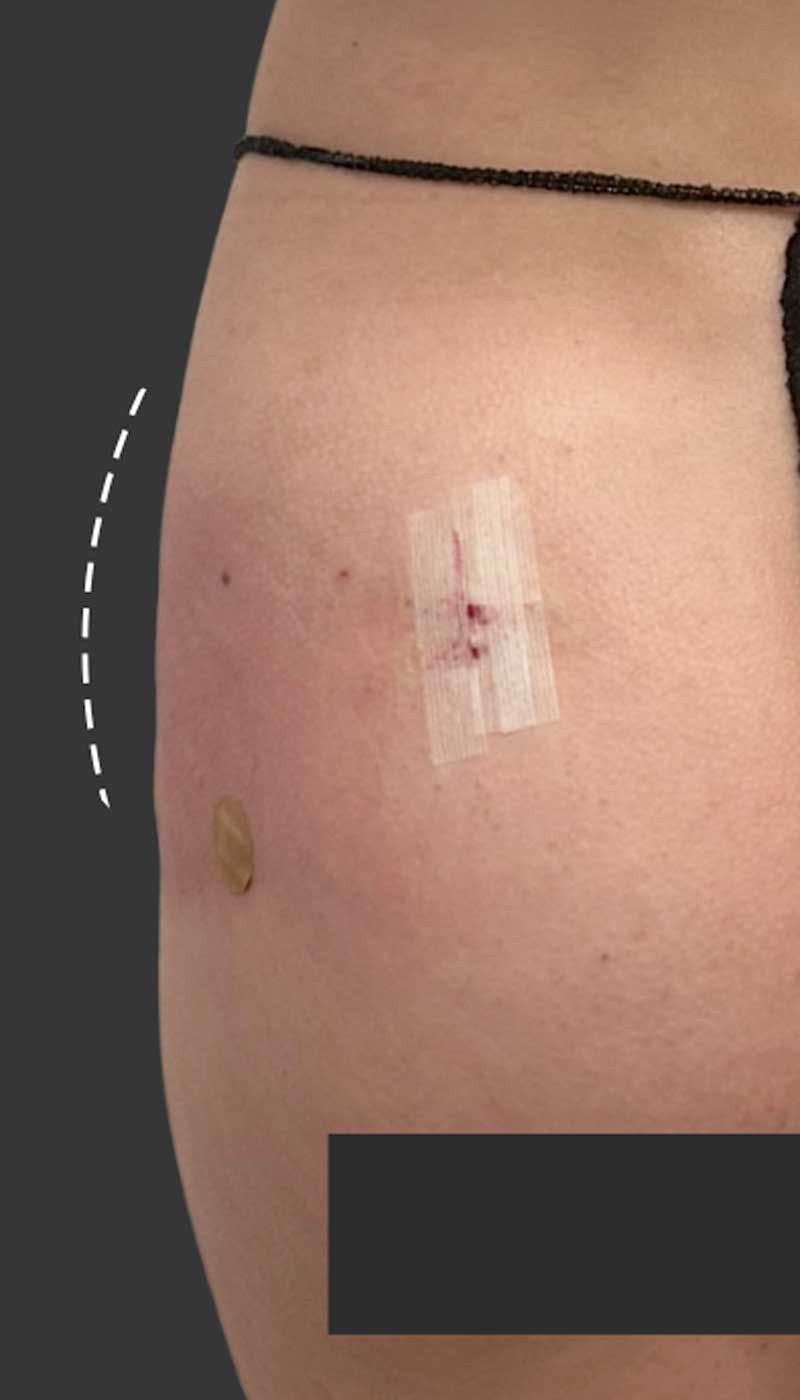 Buttlift & Hip Dips Before & After Gallery - Patient 363608 - Image 2