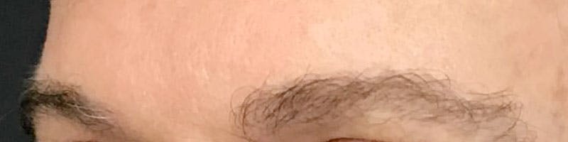 Eyebrow Transplant Before & After Gallery - Patient 335512 - Image 2