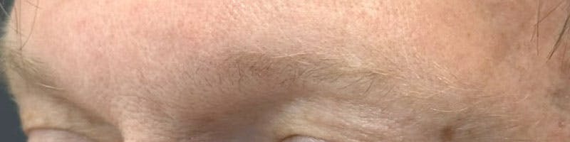 Eyebrow Transplant Before & After Gallery - Patient 335512 - Image 1