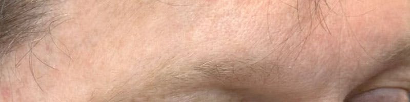 Eyebrow Transplant Before & After Gallery - Patient 218090 - Image 1